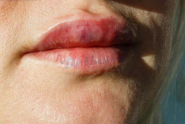 Tiêm filler môi bị sưng uống thuốc gì? Lưu ý an toàn khi tiêm