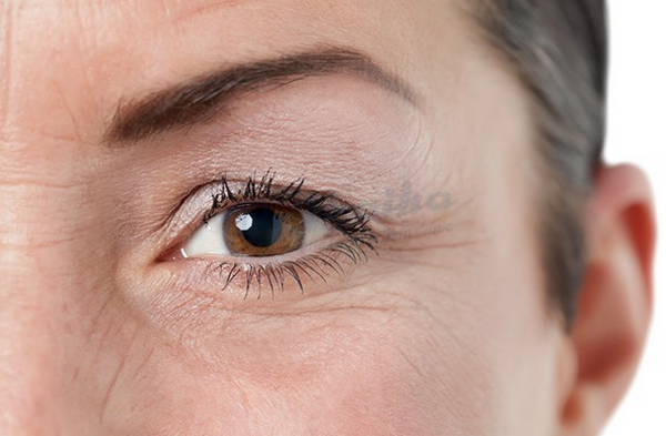 Tiêm xóa nhăn mắt có ảnh hưởng gì không? Chuyên gia chia sẻ