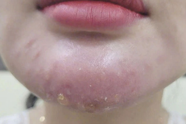 Hỏi đáp: Cách hết bầm tím khi tiêm filler?